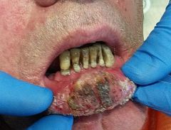 Ακανθοκυτταρικό Καρκίνωμα Στόματος