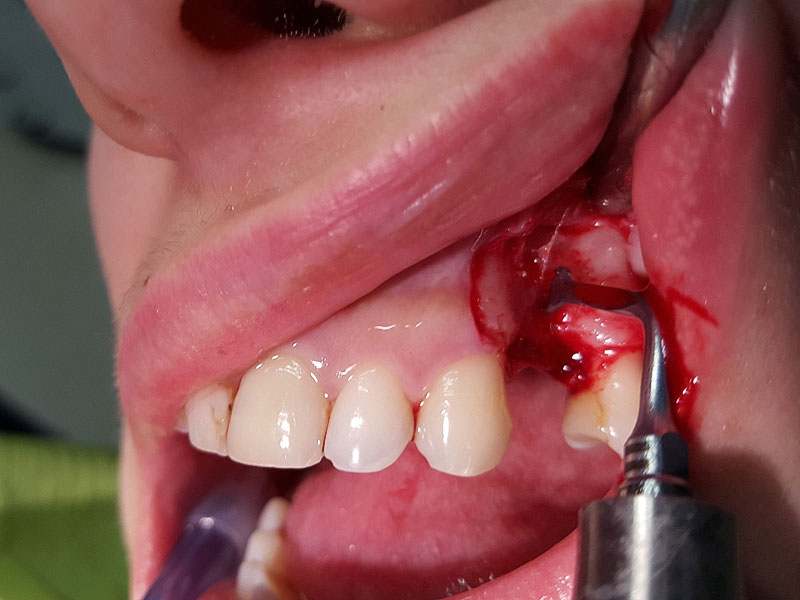 mouth-surgery-08.jpg