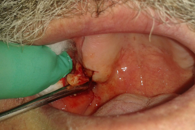 mouth-surgery1.jpg