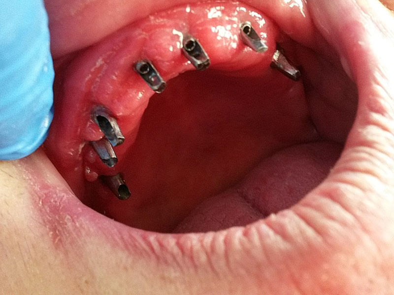 dental-implants002.jpg