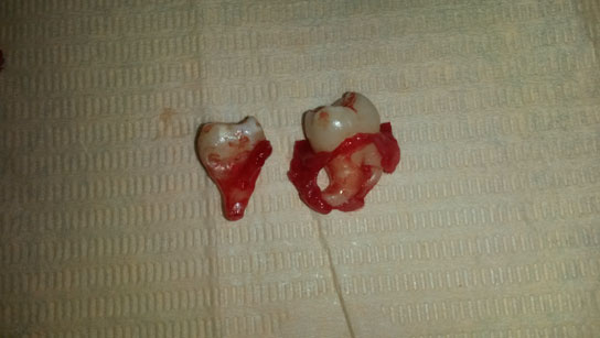 impacted-teeth(2).jpg